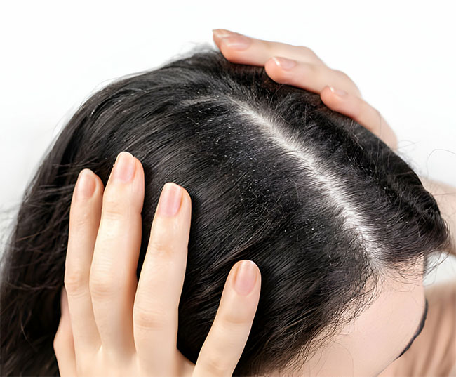 Effective Home Remedies to Deal With Dandruff